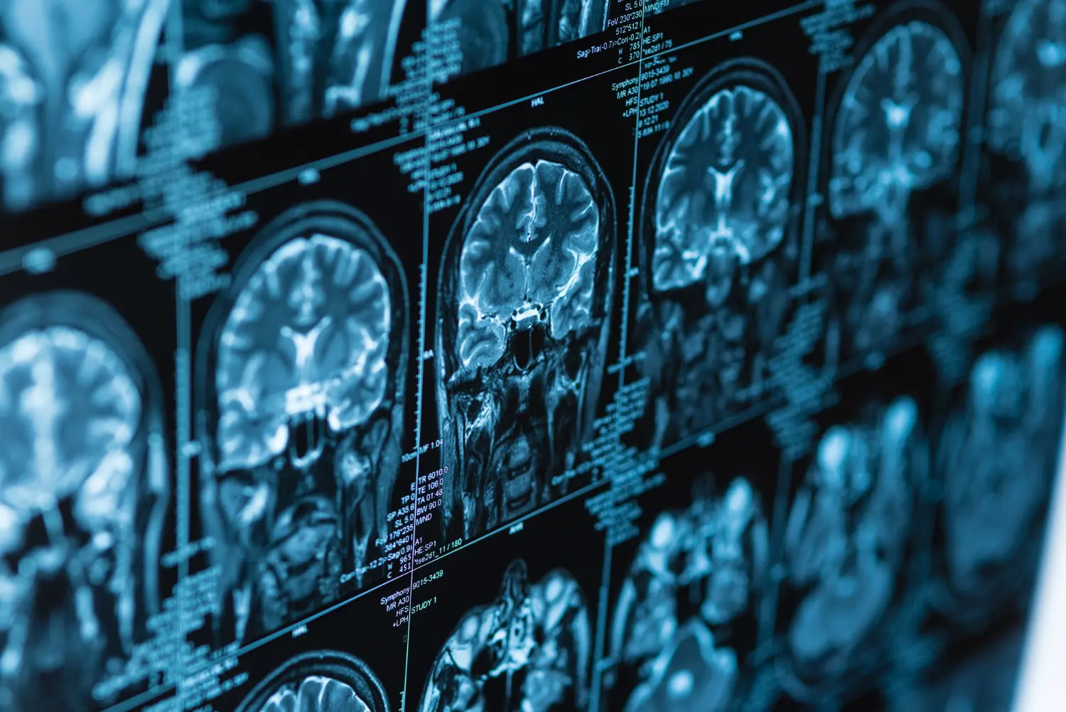 MRI scan of brain