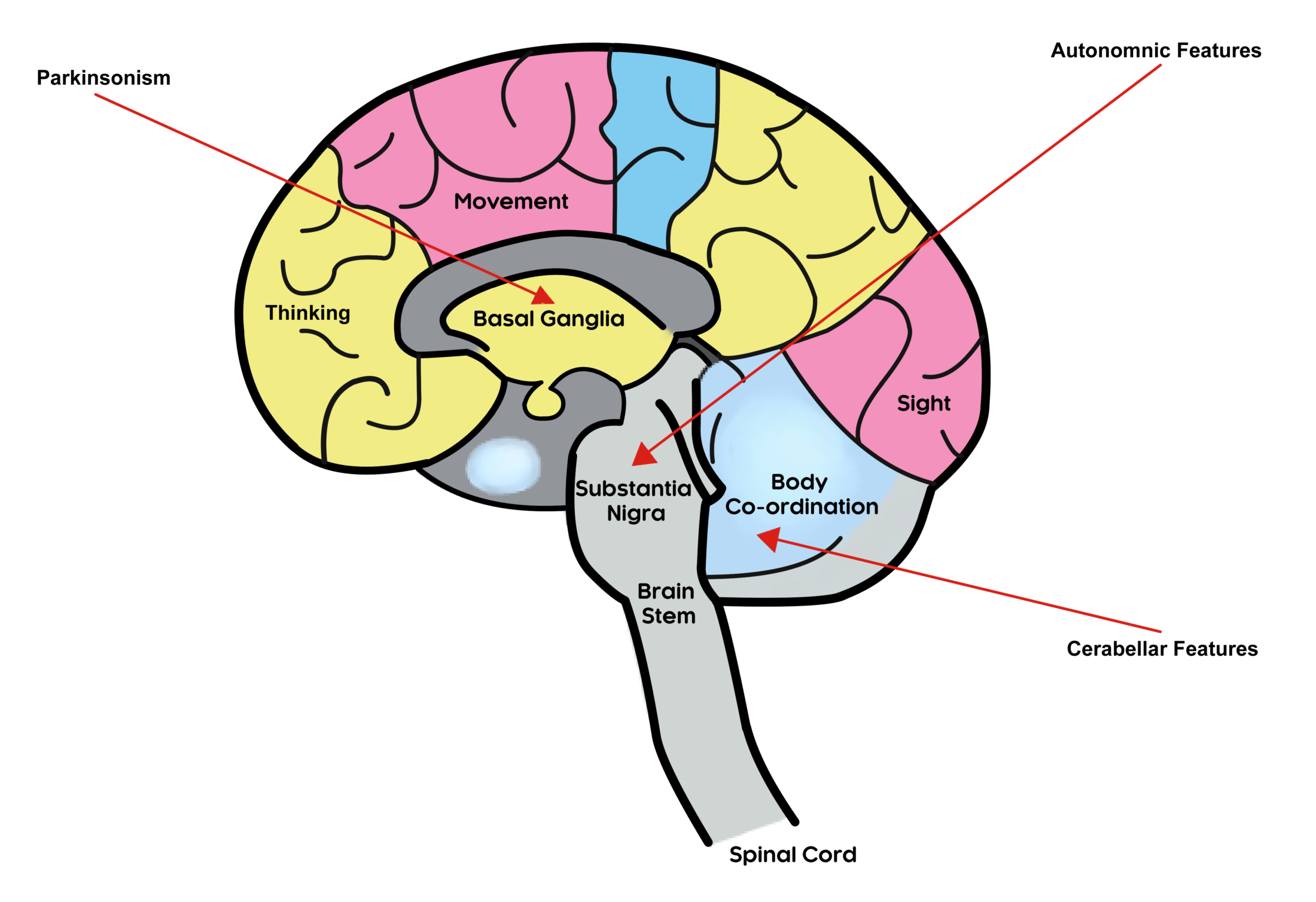 Drawing of a brain with three arrows point to the areas affected in MSA. The basal ganglia for Parkinsonism features, the brain stem for cerabellar features and the substantia nigra for autonomic features.