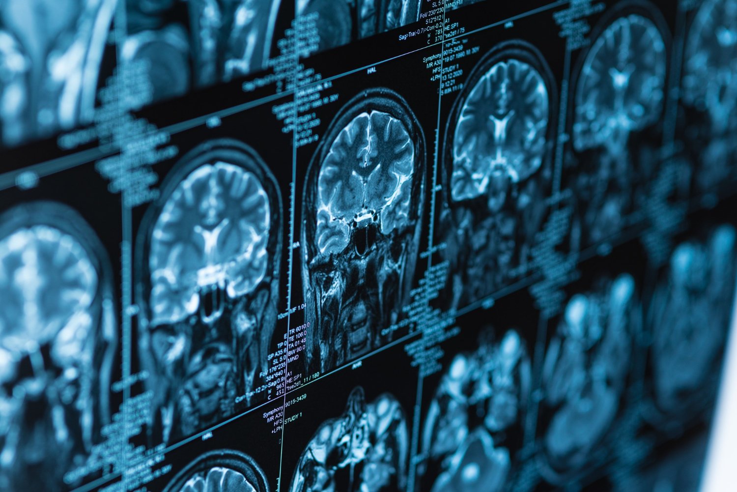MRI scan of brain